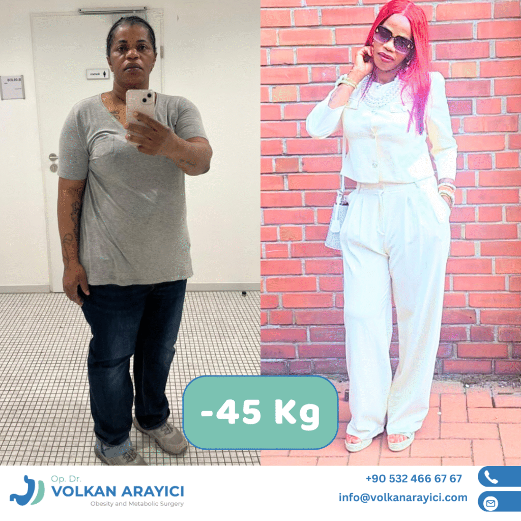 Bariatric surgery in Turkey,