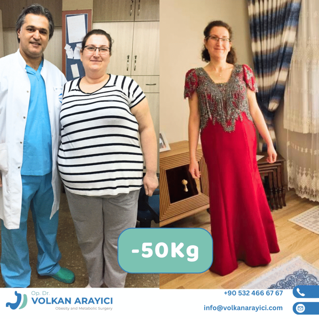 Gastric Sleeve Turkey Izmir Before After