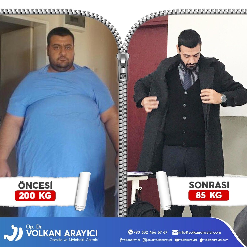 Schlauchmagen op Türkei Erfahrungen