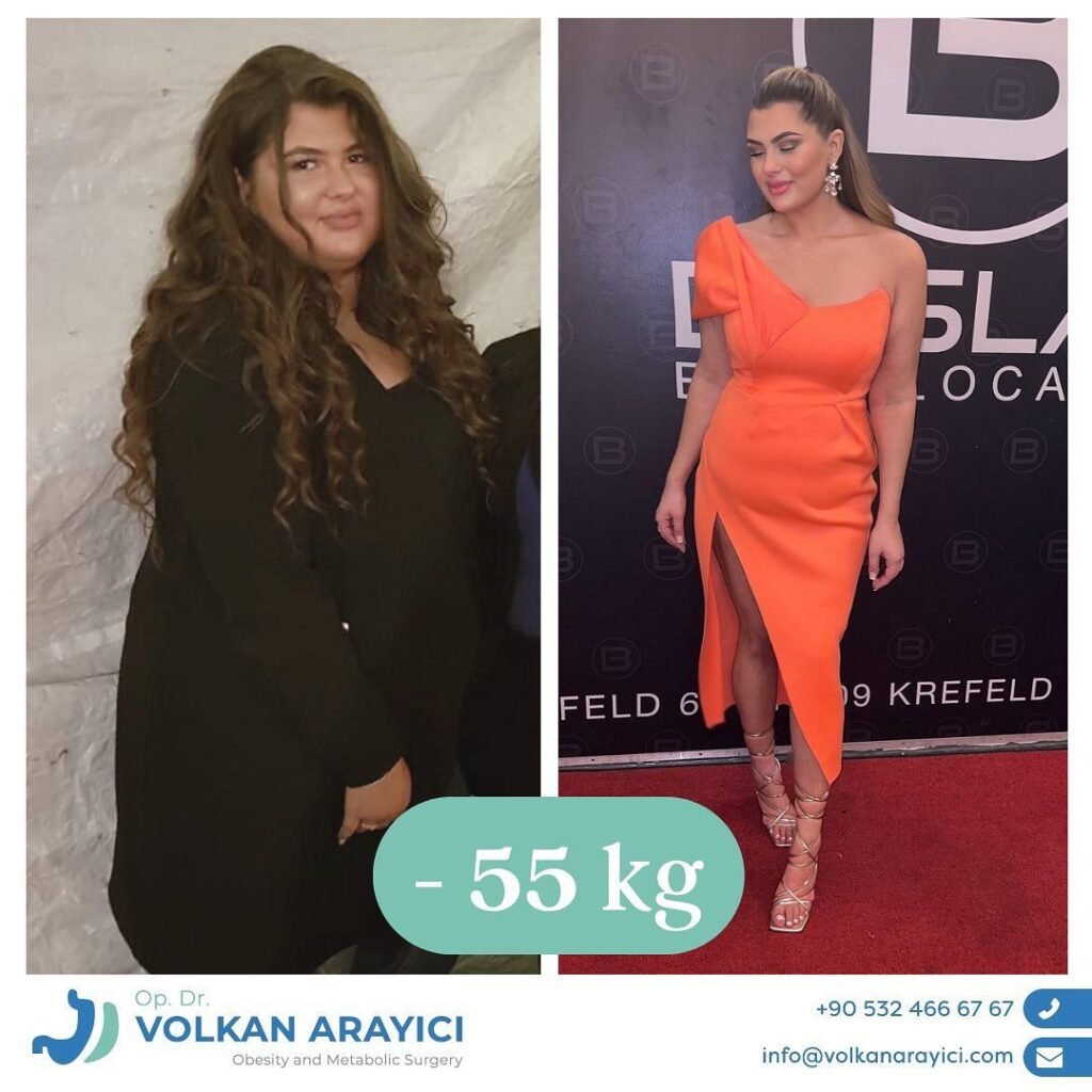 Mini Gastric Bypass Turkey