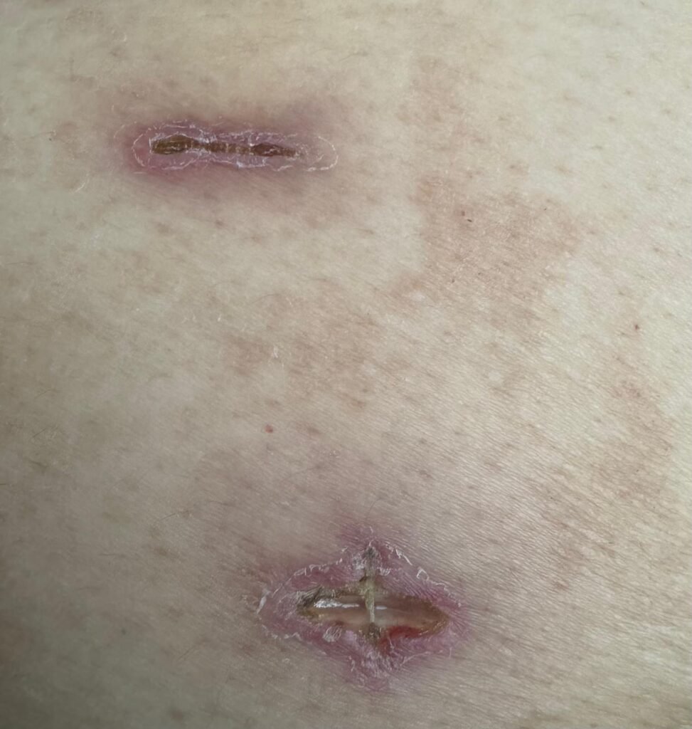 Gastric Sleeve Scars Healing