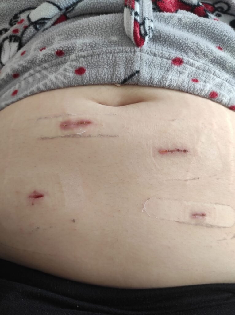 Gastric Sleeve Scars