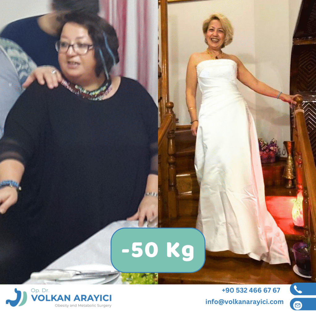 Gastric Sleeve Turkey Before After Photo