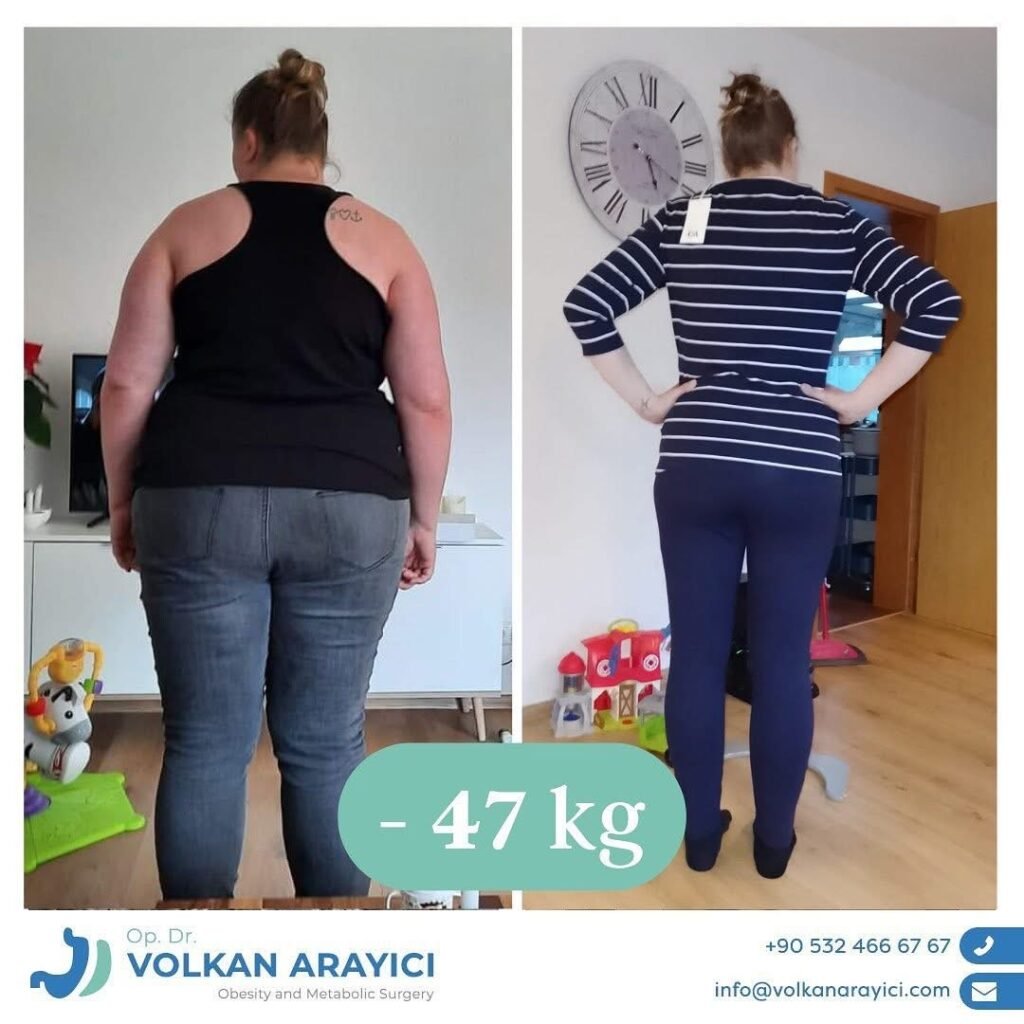Pérdida de Peso en Turquía: Su Camino hacia una Vida Saludable 3 cirugia bariatrica en turquia