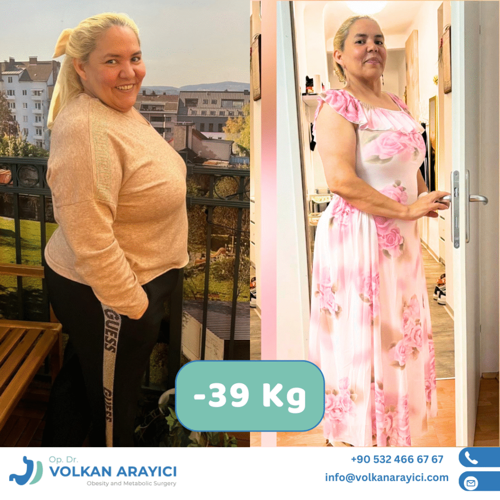 Gastric sleeve and diabetes - Christine from Germany had type 2 diabetes and took both insulin and blood sugar tablets. After her gastric sleeve surgery, she was cured of type 2 diabetes and was able to stop all her medications.