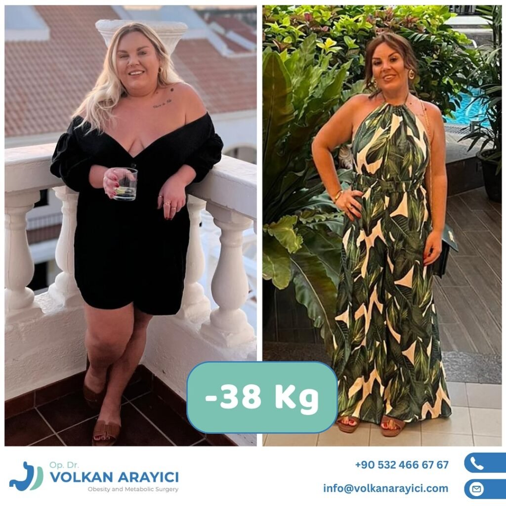 mini gastric bypass turkey Before After and Photo