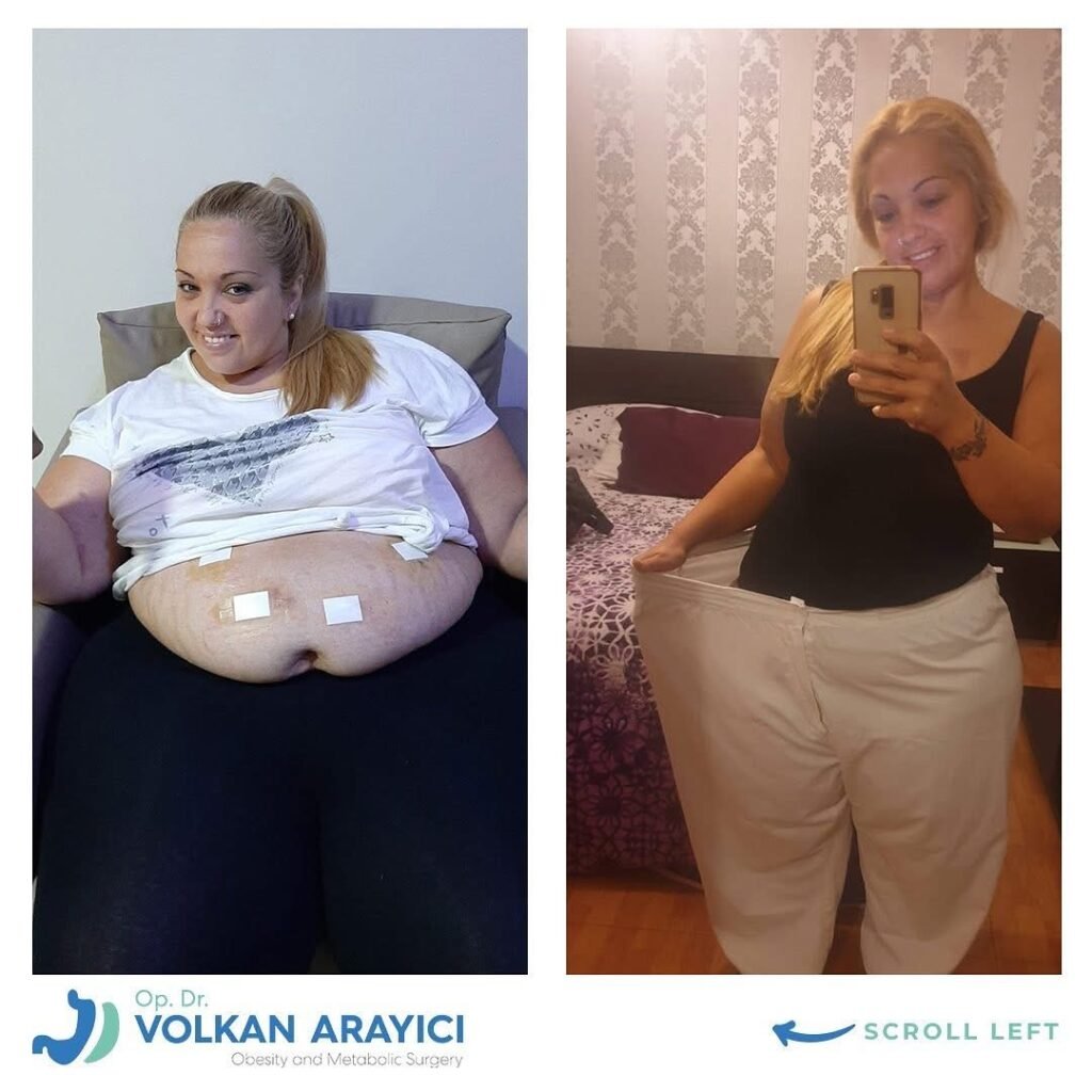 Weight Loss in Turkey: Your Path to a Healthy Life 3 weight loss turkey before after photo