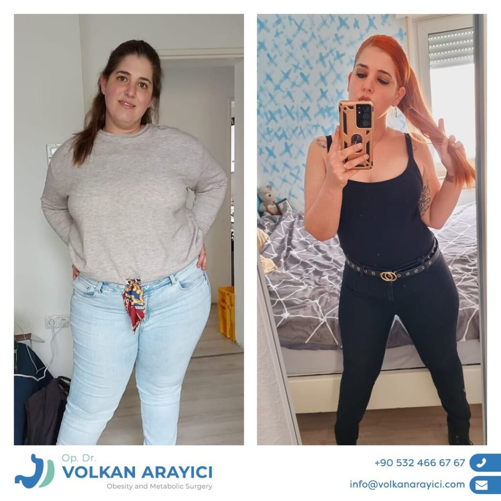 Gastric Sleeve Surgery in Turkey Dr. Volkan Arayıcı in Izmir