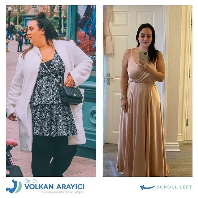 Gastric Sleeve Izmir: Turkey's Best Bariatric Surgery Gastric sleeve izmir before and after photo