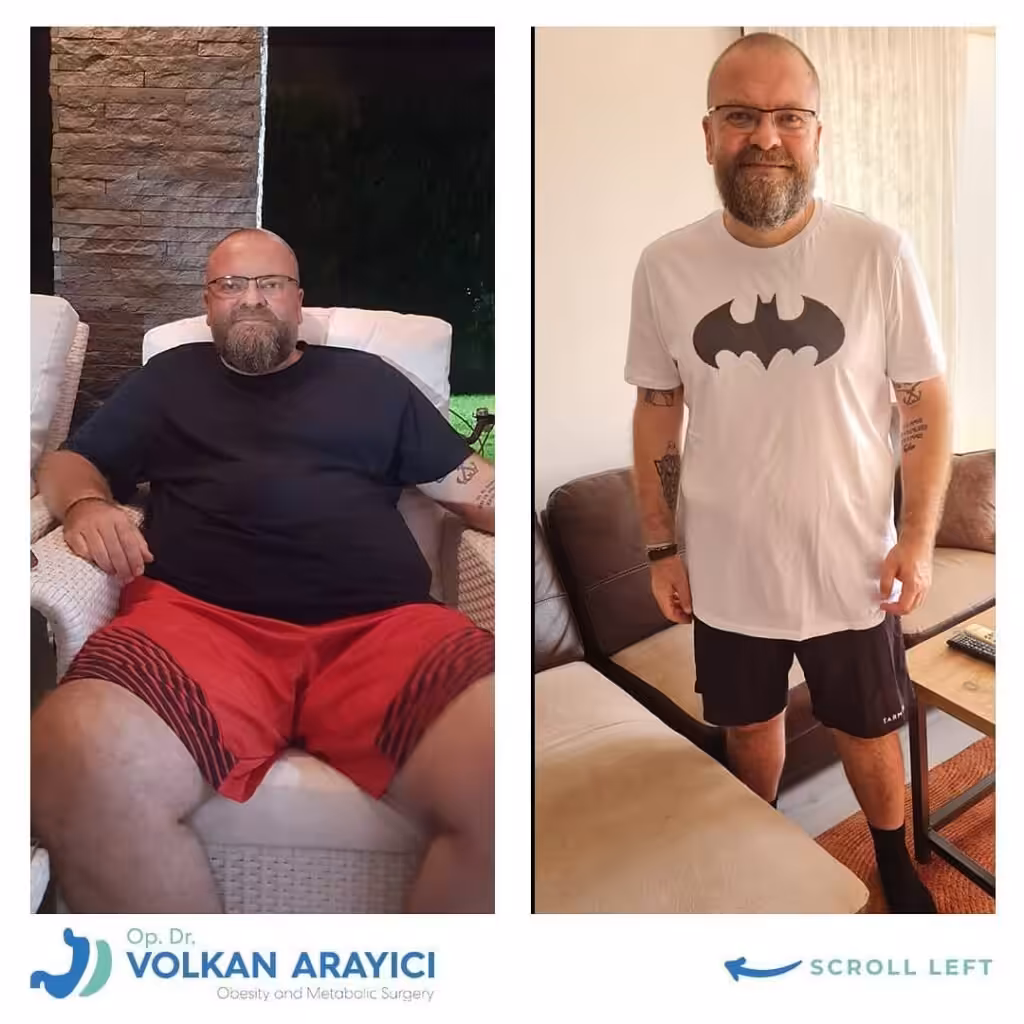 Weight Loss Surgery Cost Turkey Weight loss surgery cost izmir before and after photo