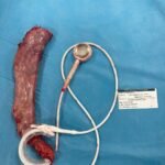 gastric band revision to sleeve