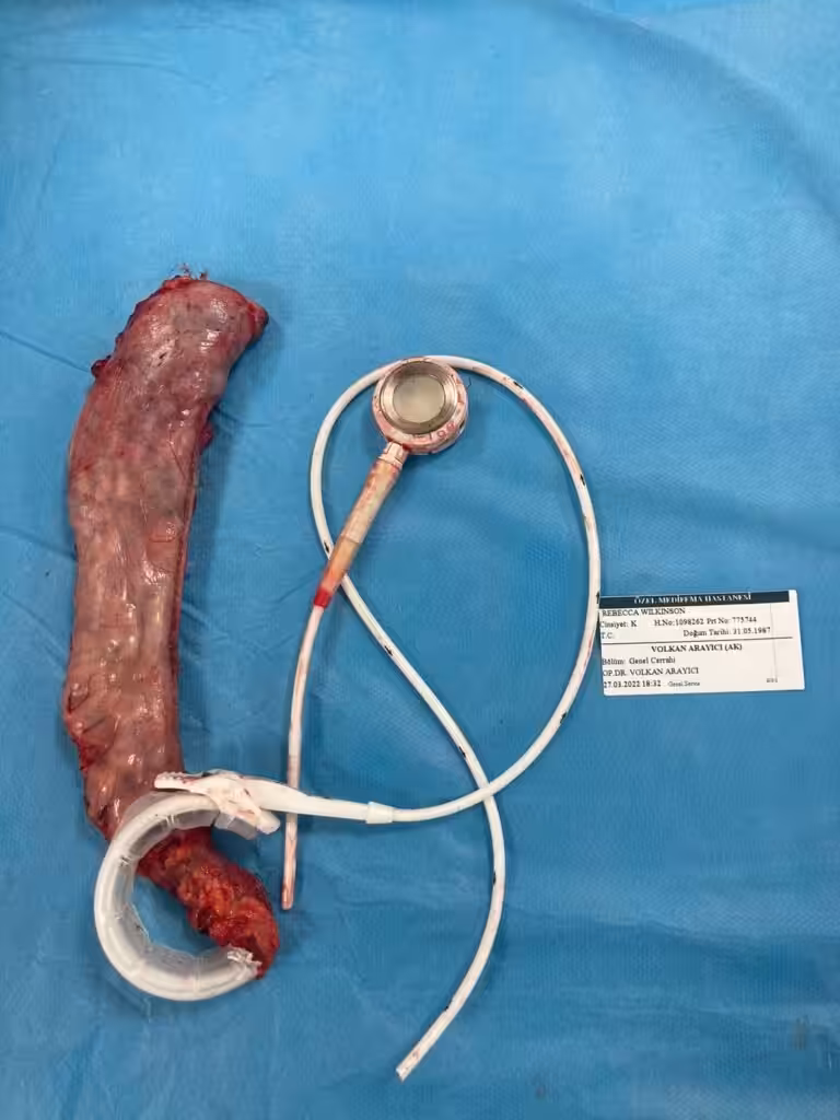 Gastric band revision to sleeve or gastric bypass gastric band revision to sleeve