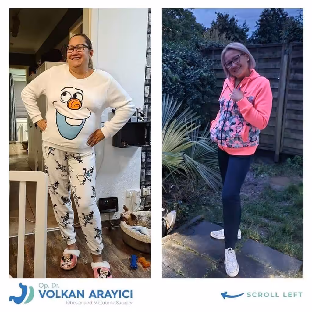 Vorteile der Schlauchmagen Revision in der Türkei bariatrische revision türkei