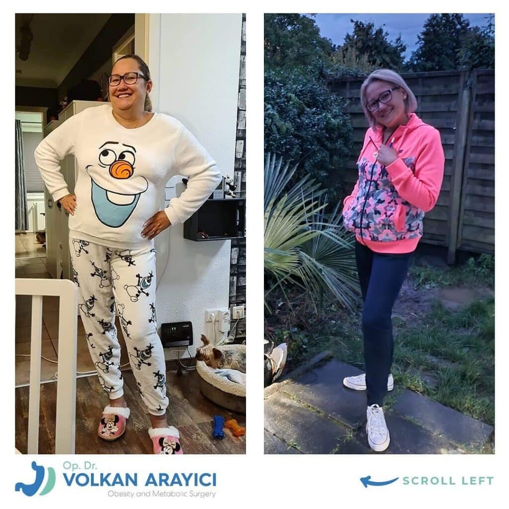 Vorteile der Schlauchmagen Revision in der Türkei bariatrische revision türkei