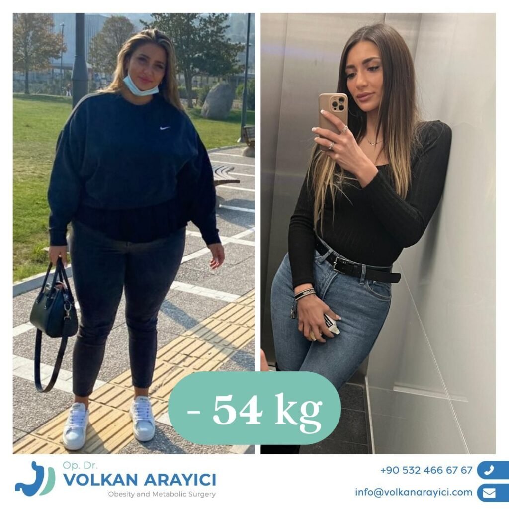 Stomach reduction in Turkey