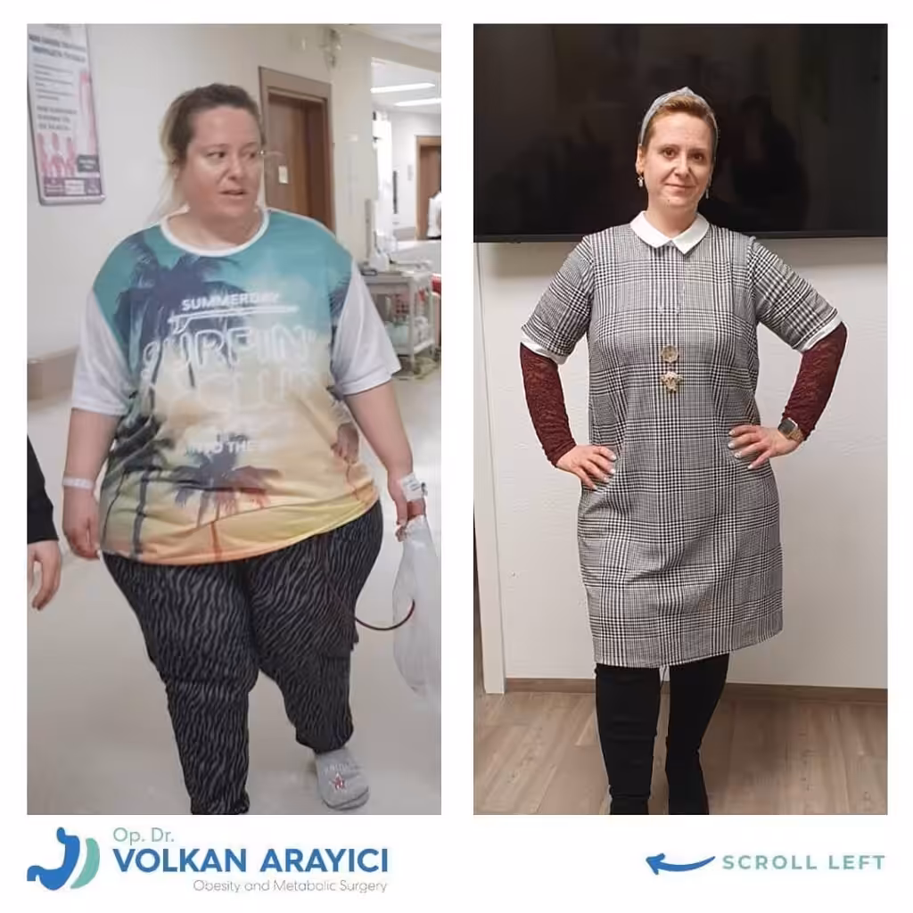 Gastric band revision to sleeve or gastric bypass gastric band revision to sleeve