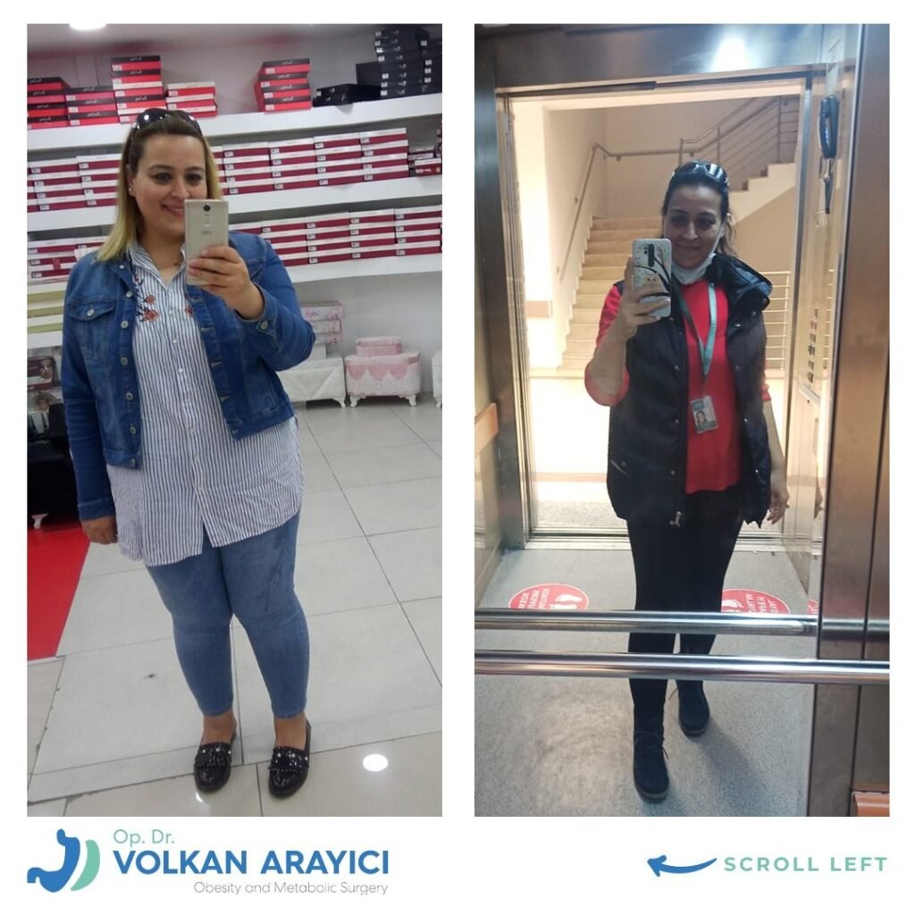 gastric band to sleeve before after photo