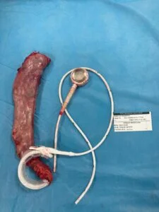 gastric band to sleeve conversion