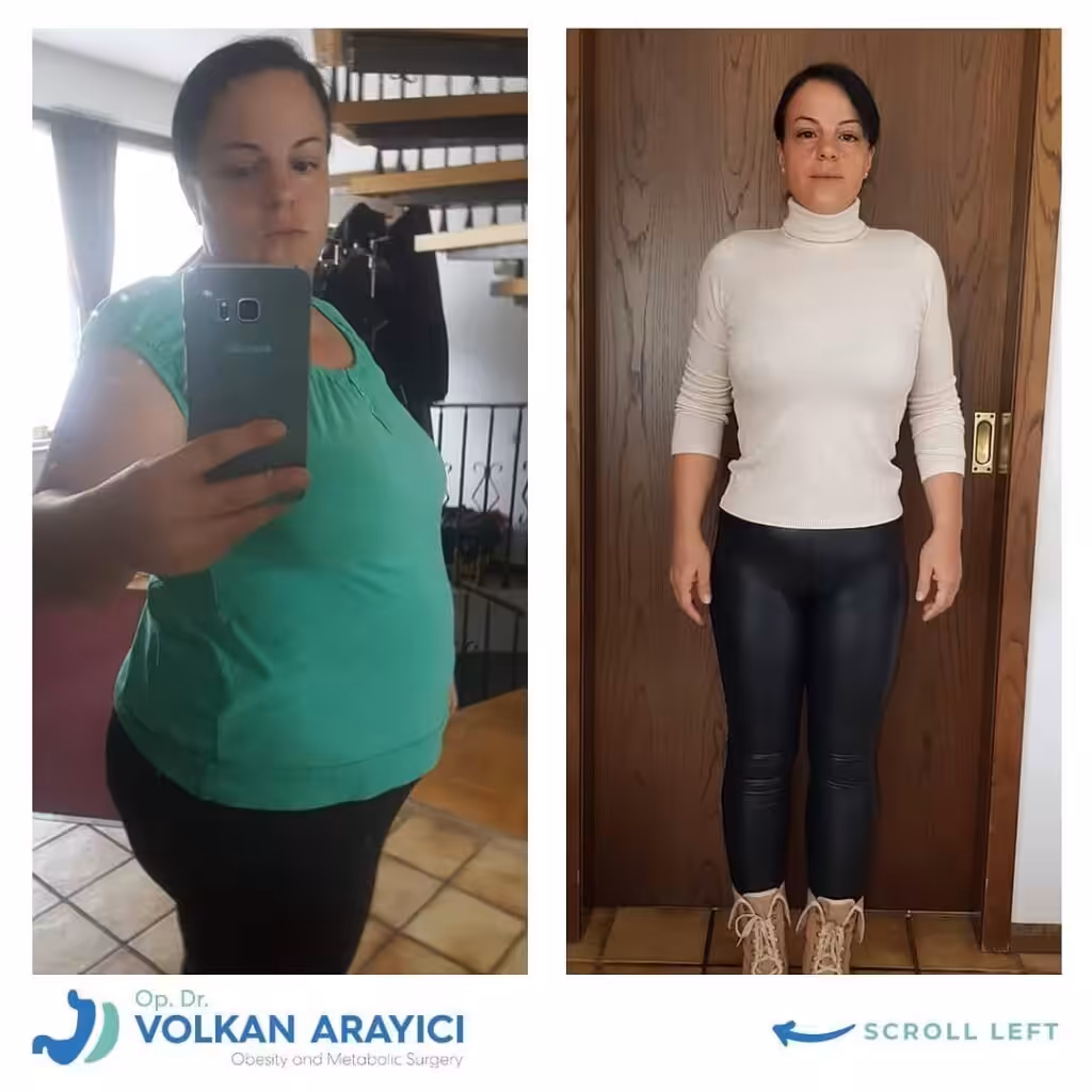 Gastric band revision to sleeve or gastric bypass gastric sleeve after gastric band