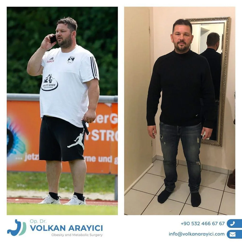 Entfernung des Magenbandes und Umstellung auf Schlauchmagen oder Magenbypass Magenband Revisionoperation magenband revision in der türkei Vorher nachher