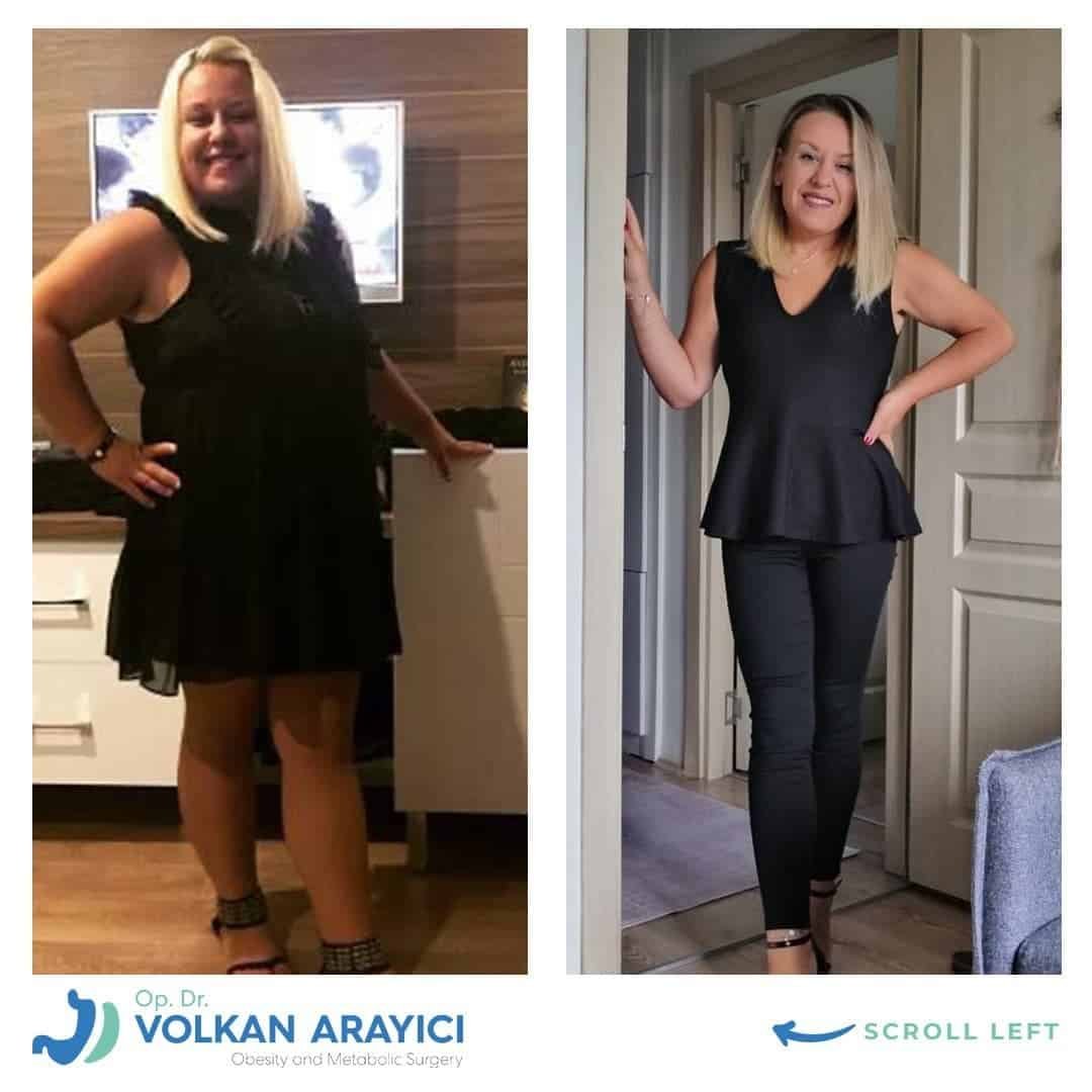 magenverkleinerung revision in der türkei