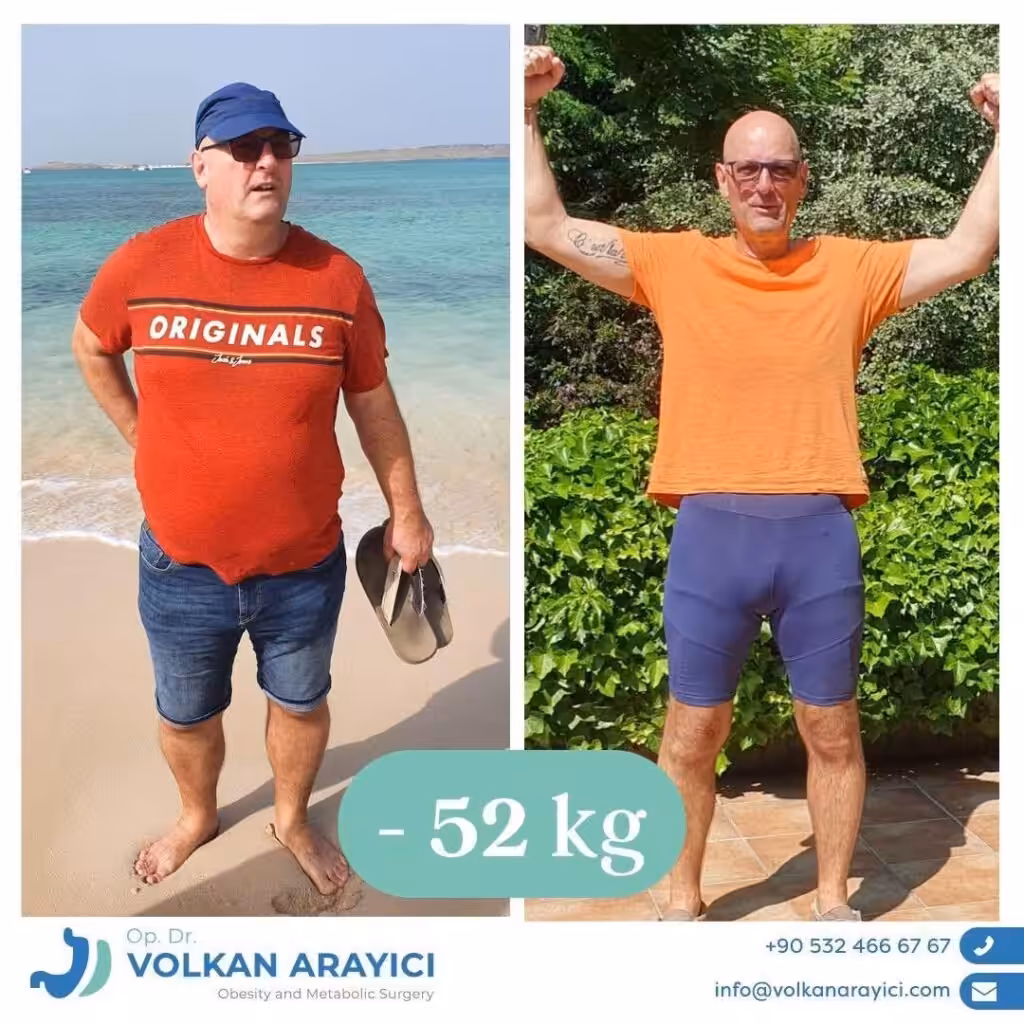 ¿Manga Gástrica O Mini Bypass Gástrico? manga gastrica o mini bypass gastrico