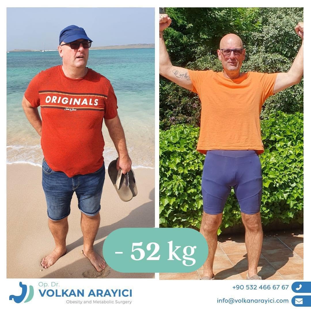 manga gastrica o mini bypass gastrico