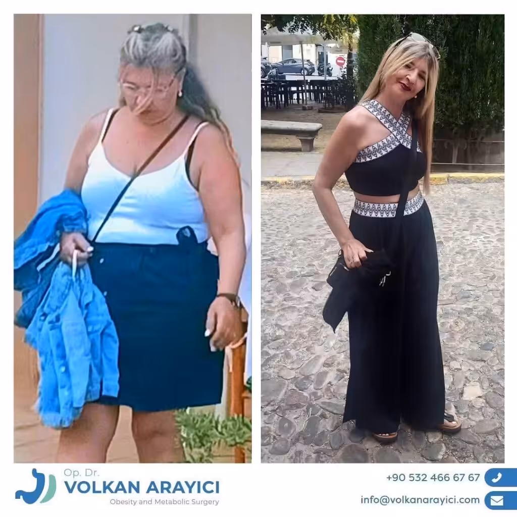 ¿Manga Gástrica O Mini Bypass Gástrico? manga gastrica o mini bypass gastrico