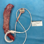 Gleichzeitige Magenbandentfernung und Schlauchmagen von Dr. Volkan Arayıcı: 4 Magenband Revision