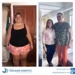 Reducción de estómago Turquía reduccion de estomago turquia