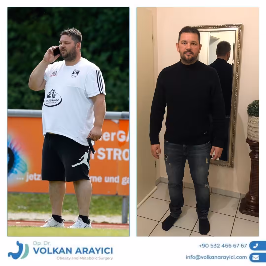 Entdecken Sie Ihren Weg zu Gesundheit mit bariatrische Chirurgie in der Türkei sans titre 3 l5XYa 1
