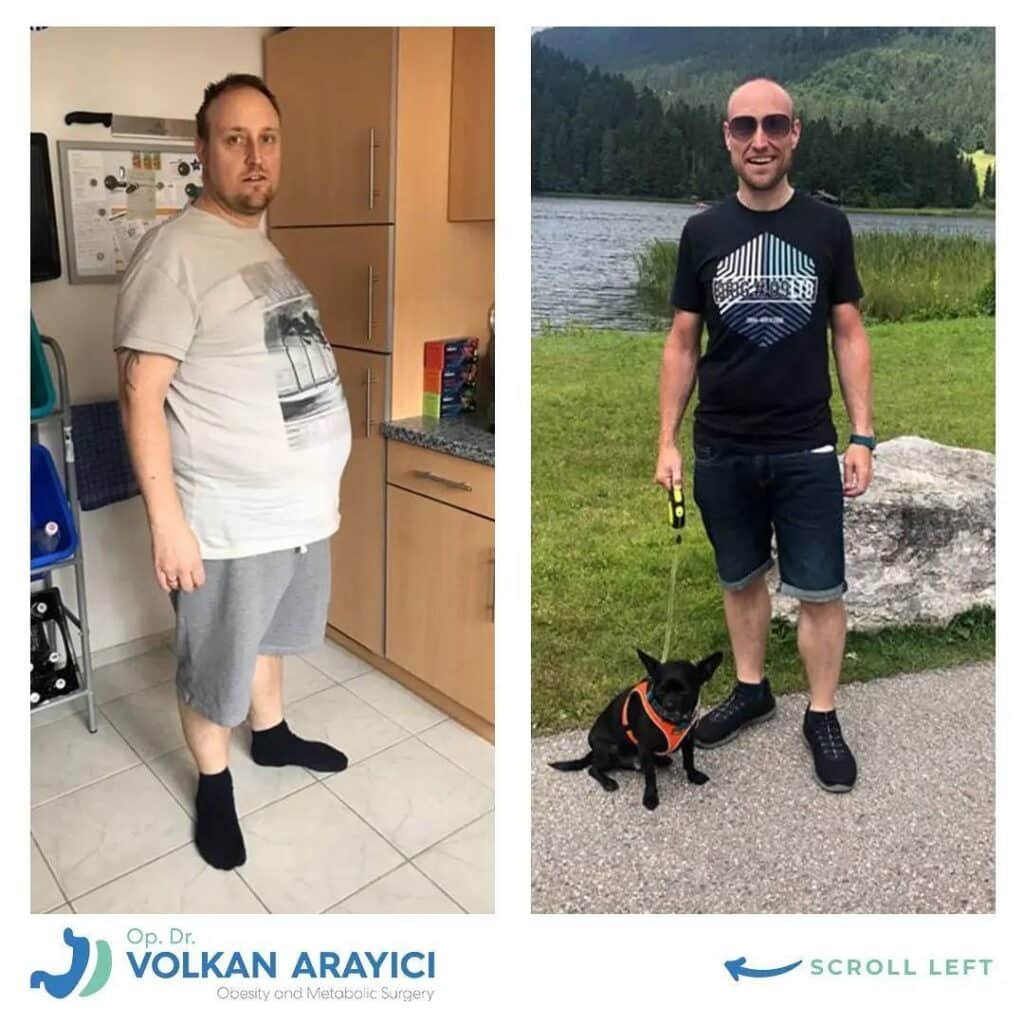 Vorteile der Schlauchmagen Revision in der Türkei schlauchmagen revision in der Türkei