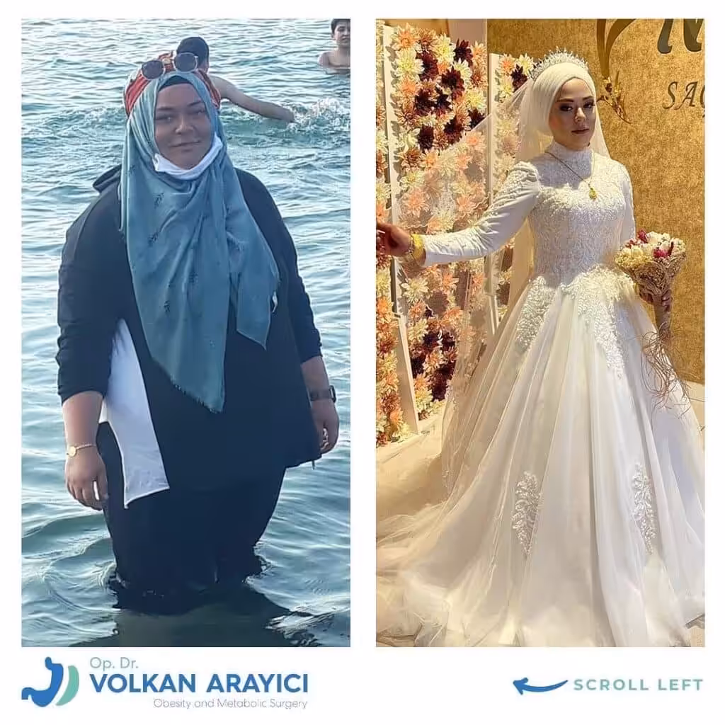 Vorteile der Schlauchmagen Revision in der Türkei schlauchmagen revision türkei