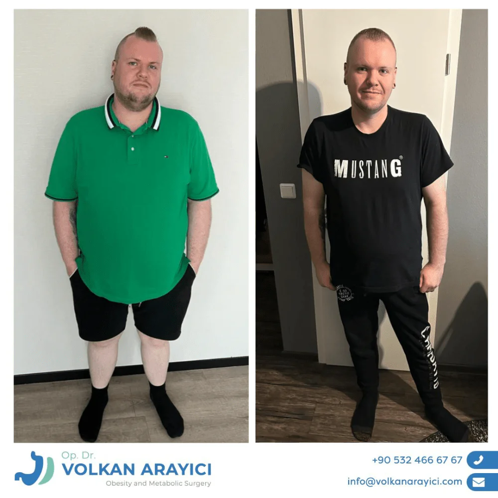 Alkoholkonsum nach Magenverkleinerung operation alkoholkonsum nach magenverkleinerung