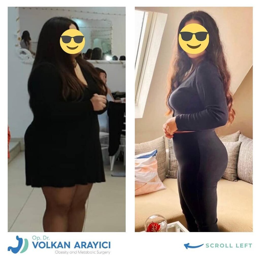 Was ist eine Magenverkleinerung? was ist eine magenbypass?