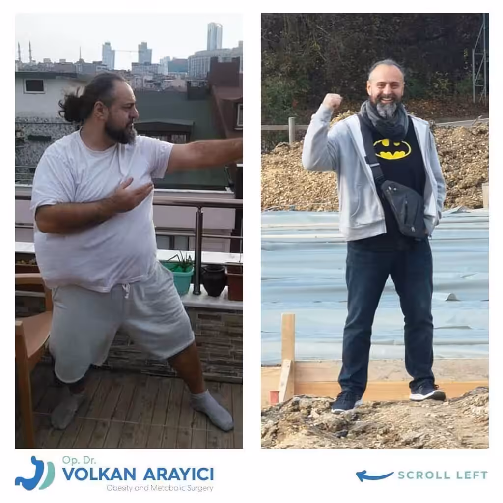 Weight Loss Surgery Cost Turkey weight loss surgery cost turkey before and after photo