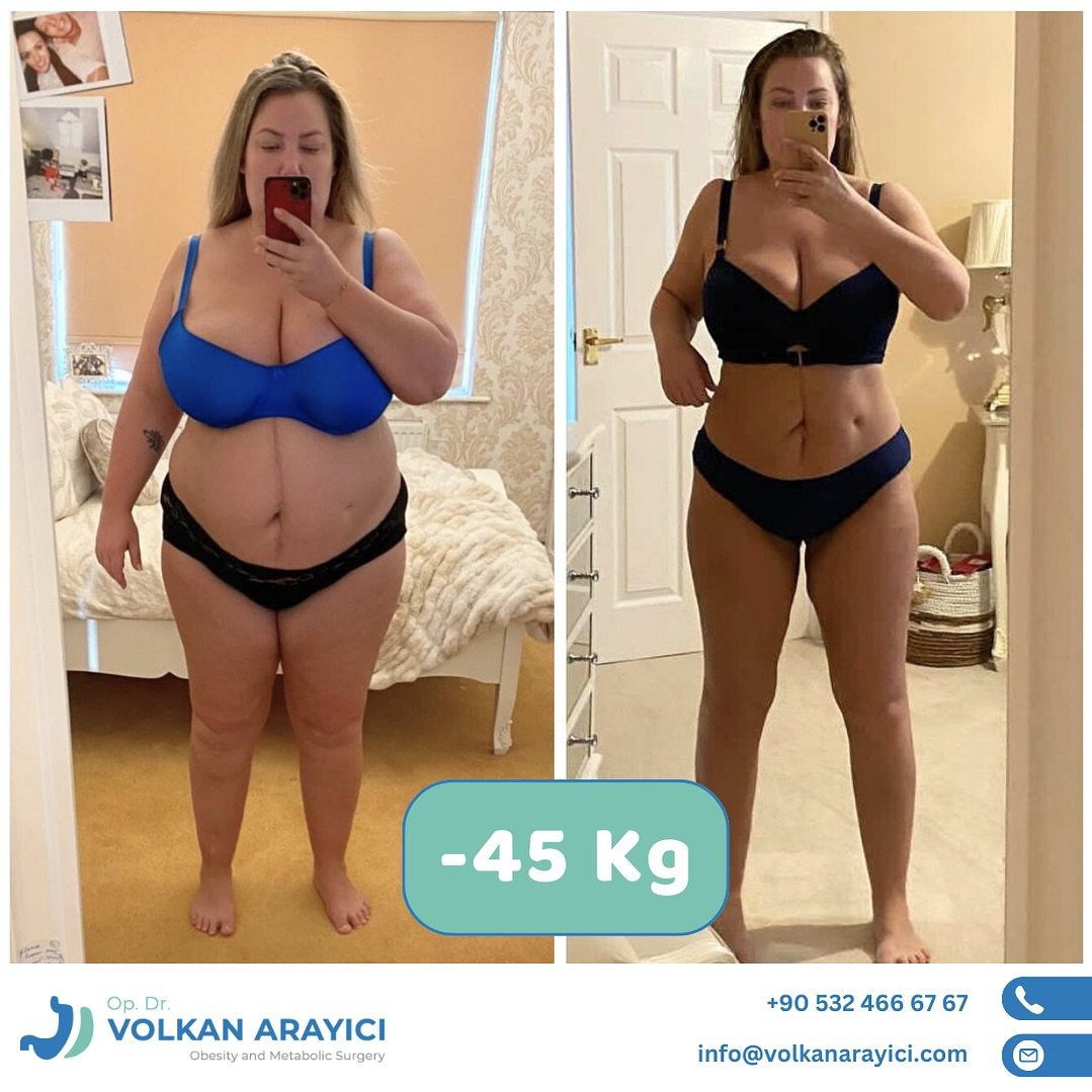 Gastrik Sleeve izmir