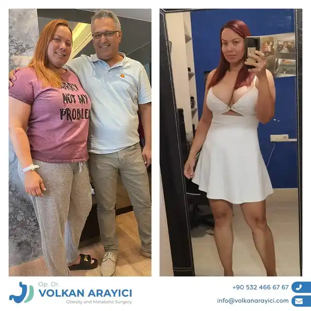 Magenverkleinerung İzmir vorher nachher