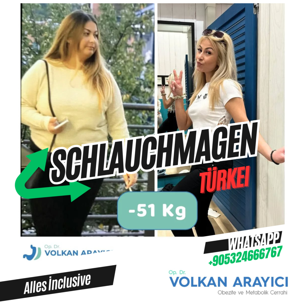 Magenverkleinerung İzmir vorher nachher