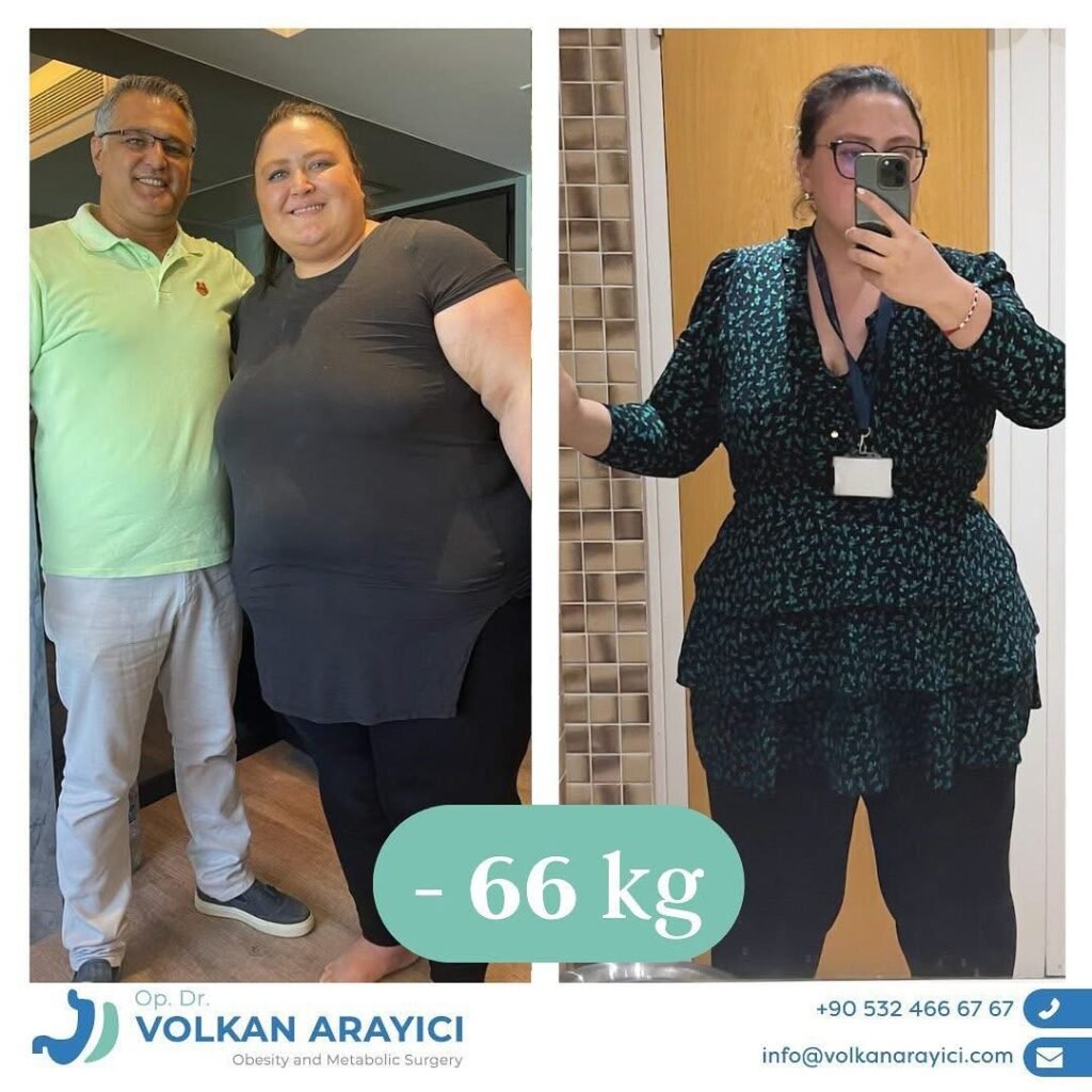 Magenverkleinerung izmir kosten Vorher Nachher 