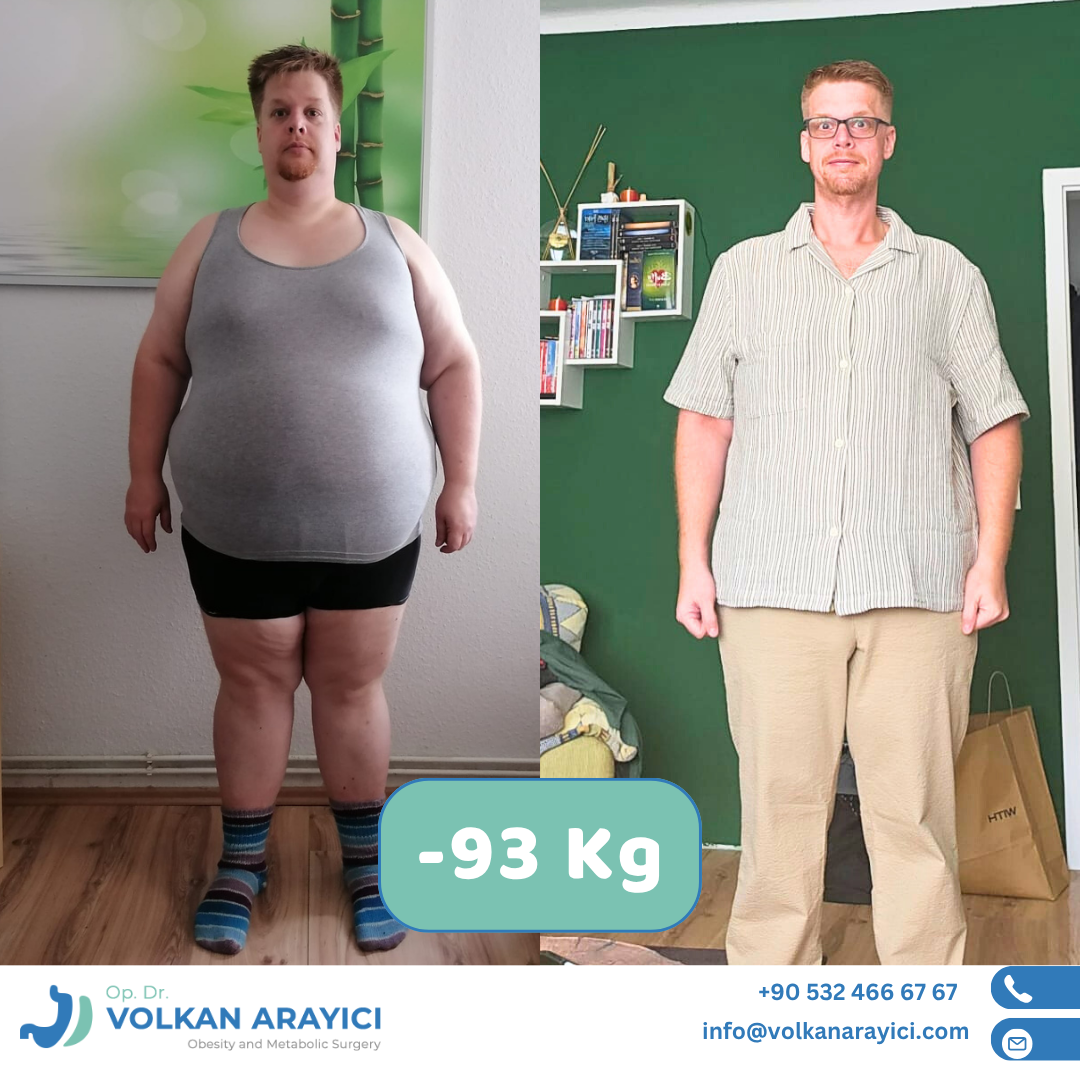 Magen Op in der Türkei Erfahrungen - Dr.Volkan Arayıcı