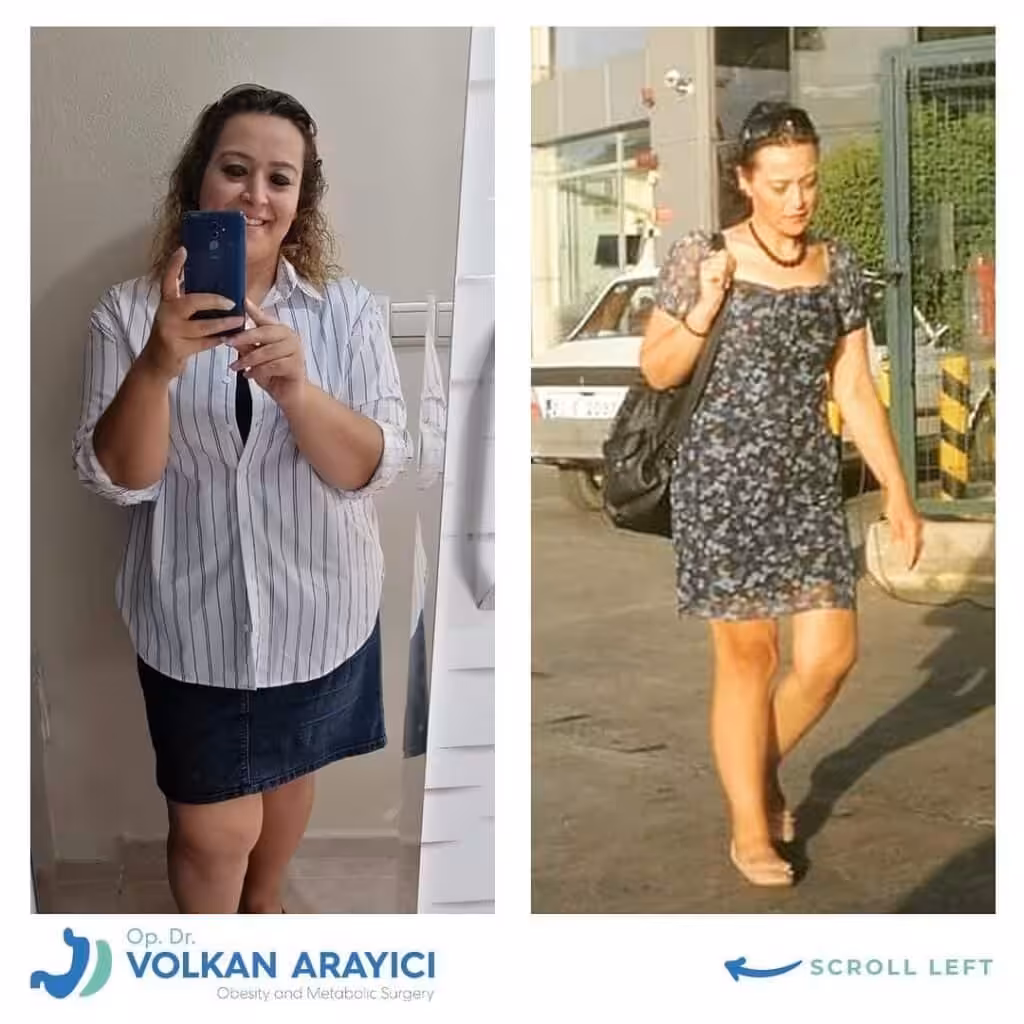 Magen Op Türkei: Kosten, Vorteile und Erfahrungen magen op türkei izmir kosten