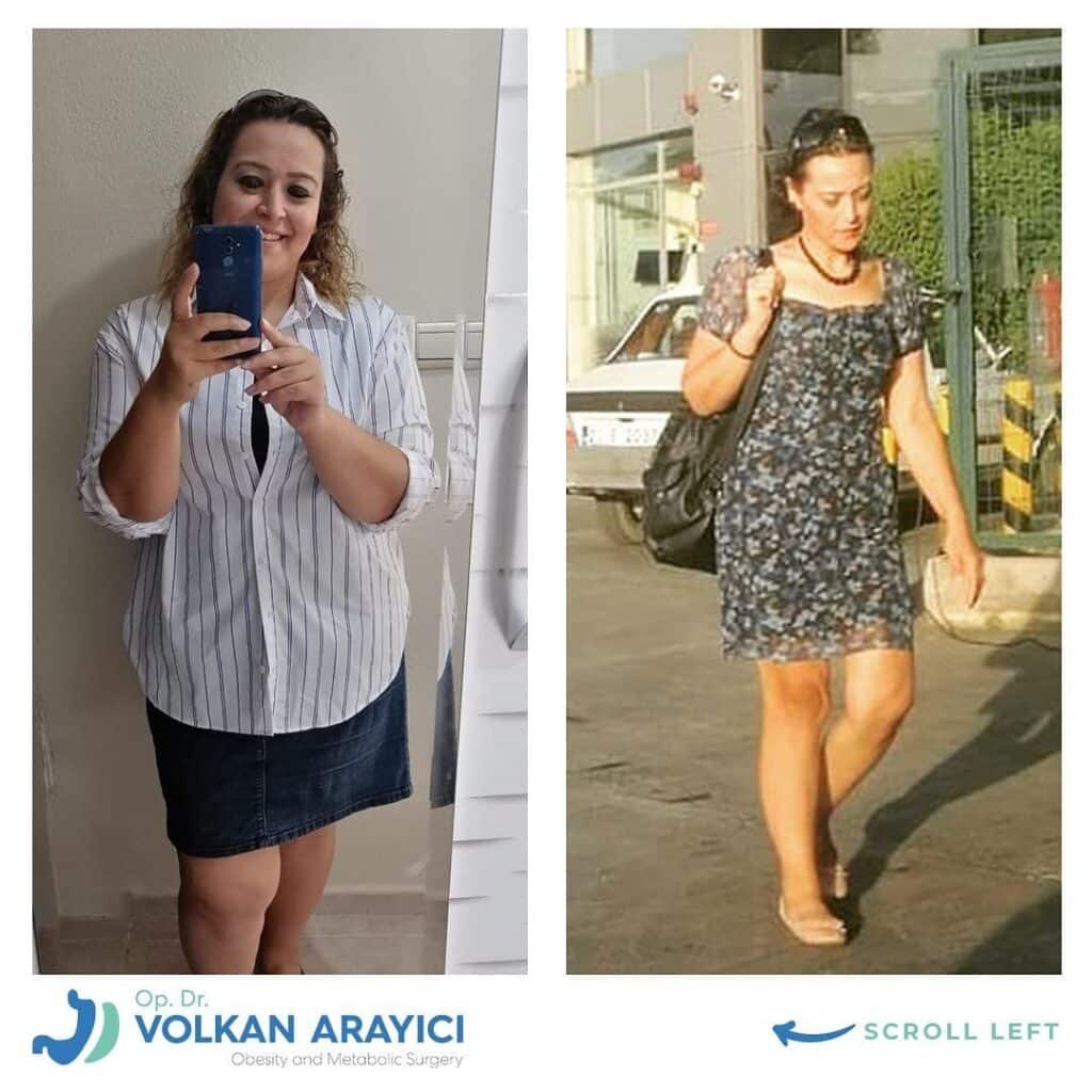 magen op türkei kosten