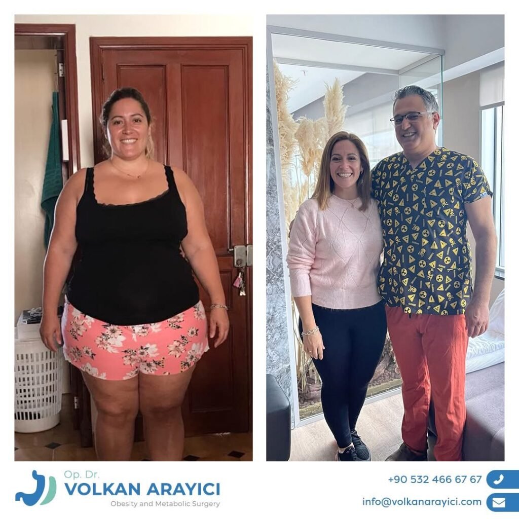 magenverkleinerung kosten türkei Vorher Nachher bild