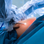 Magenverkleinerung in der Türkei: Lebensqualität verbessern mit Adipositas chirurgie Magenverkleinerung in der Türkei: Lebensqualität verbessern mit Adipositaschirurgie