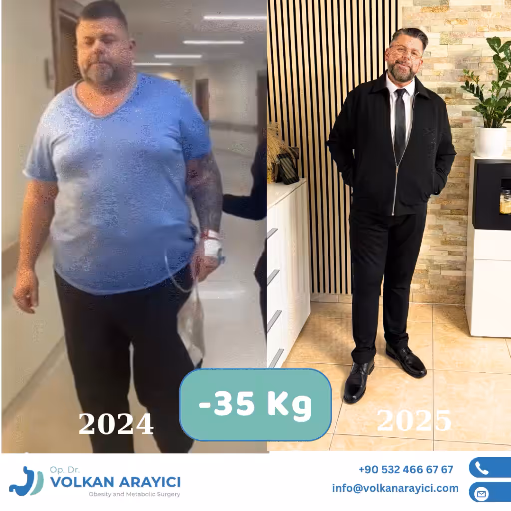 Which is the Best Gastric Sleeve Clinic? best gastric sleeve clinic in turkey before after photo