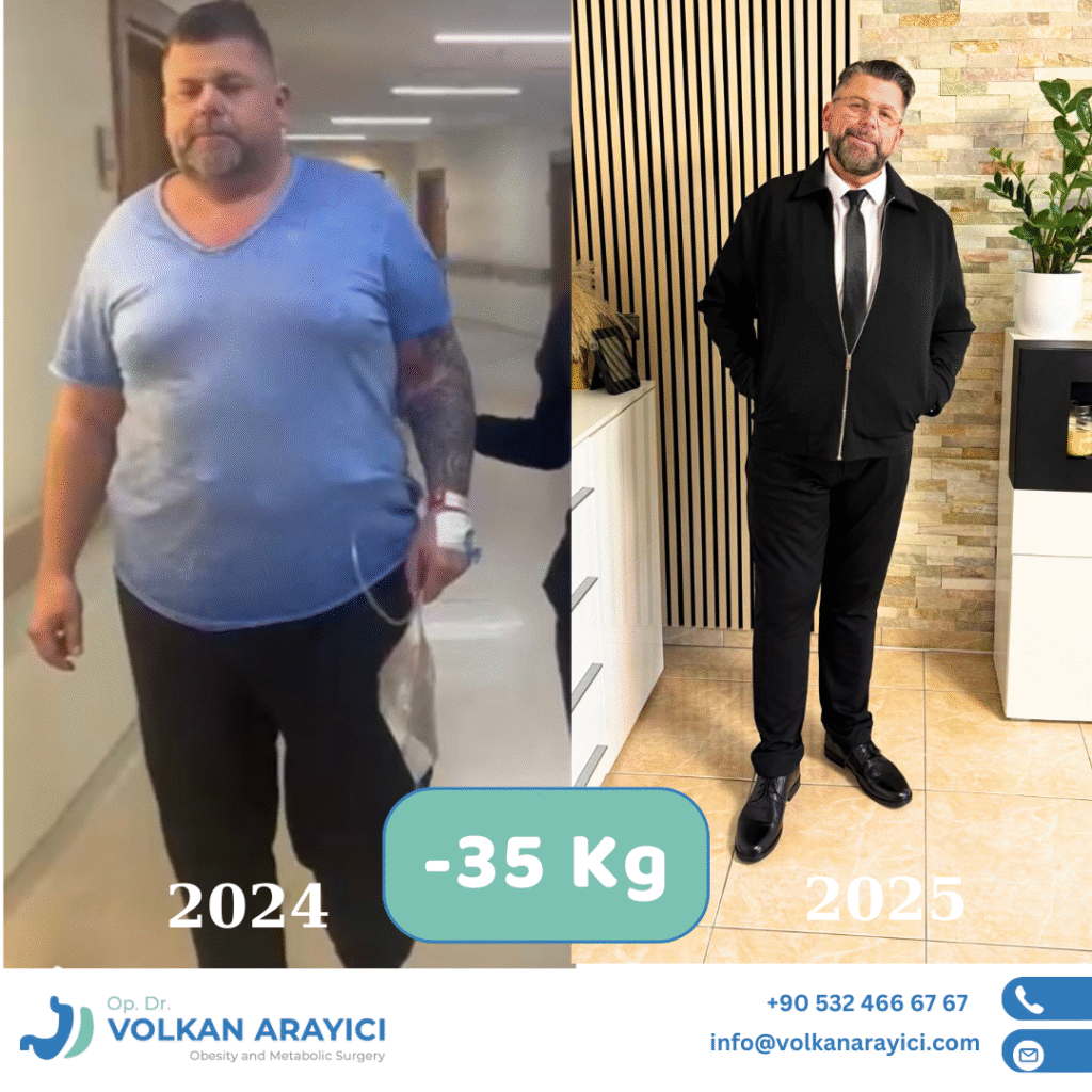 best gastric sleeve clinic in turkey before after photo