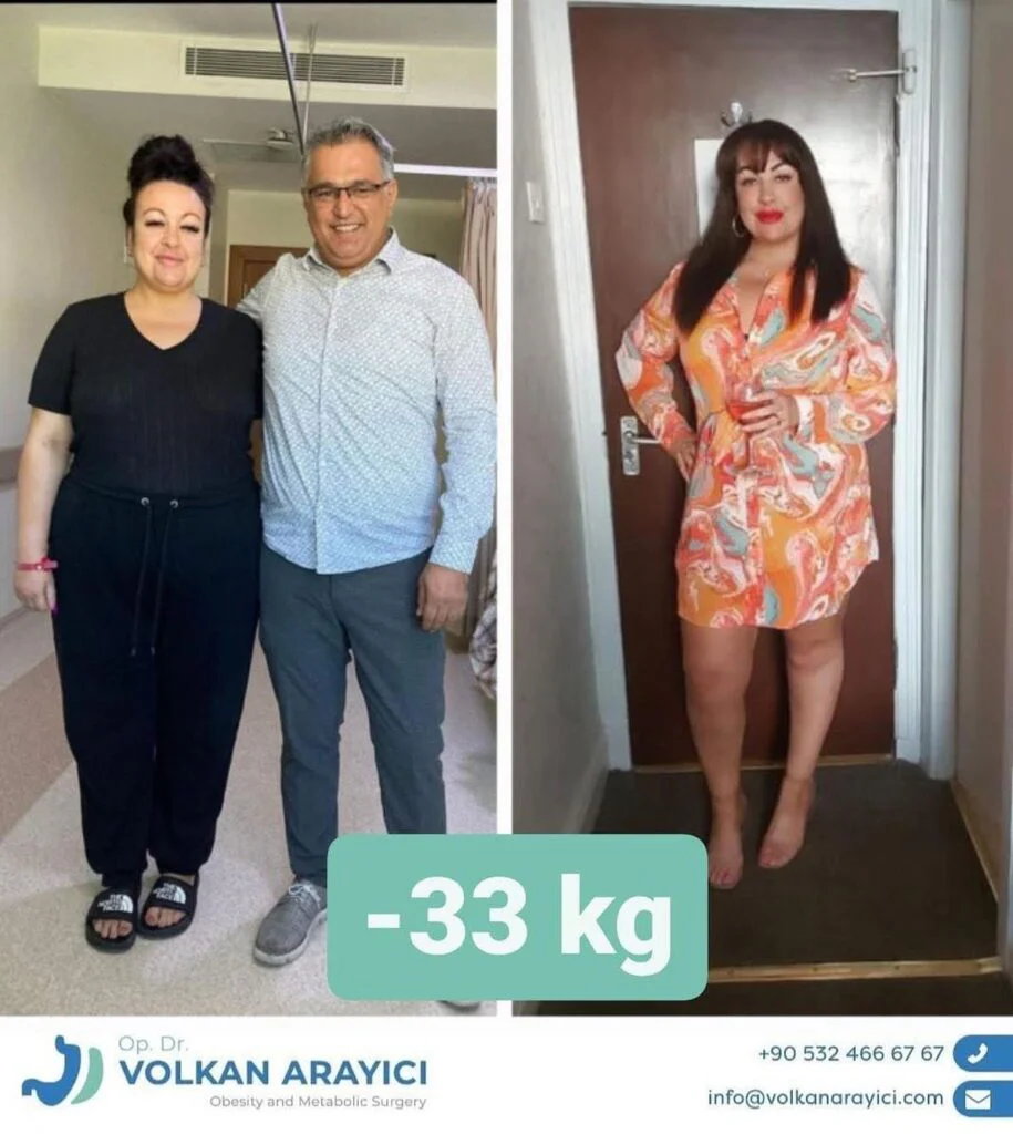 Which is the Gastric Sleeve Best Clinic in Turkey? best gastric sleeve surgeon in turkey before after photo