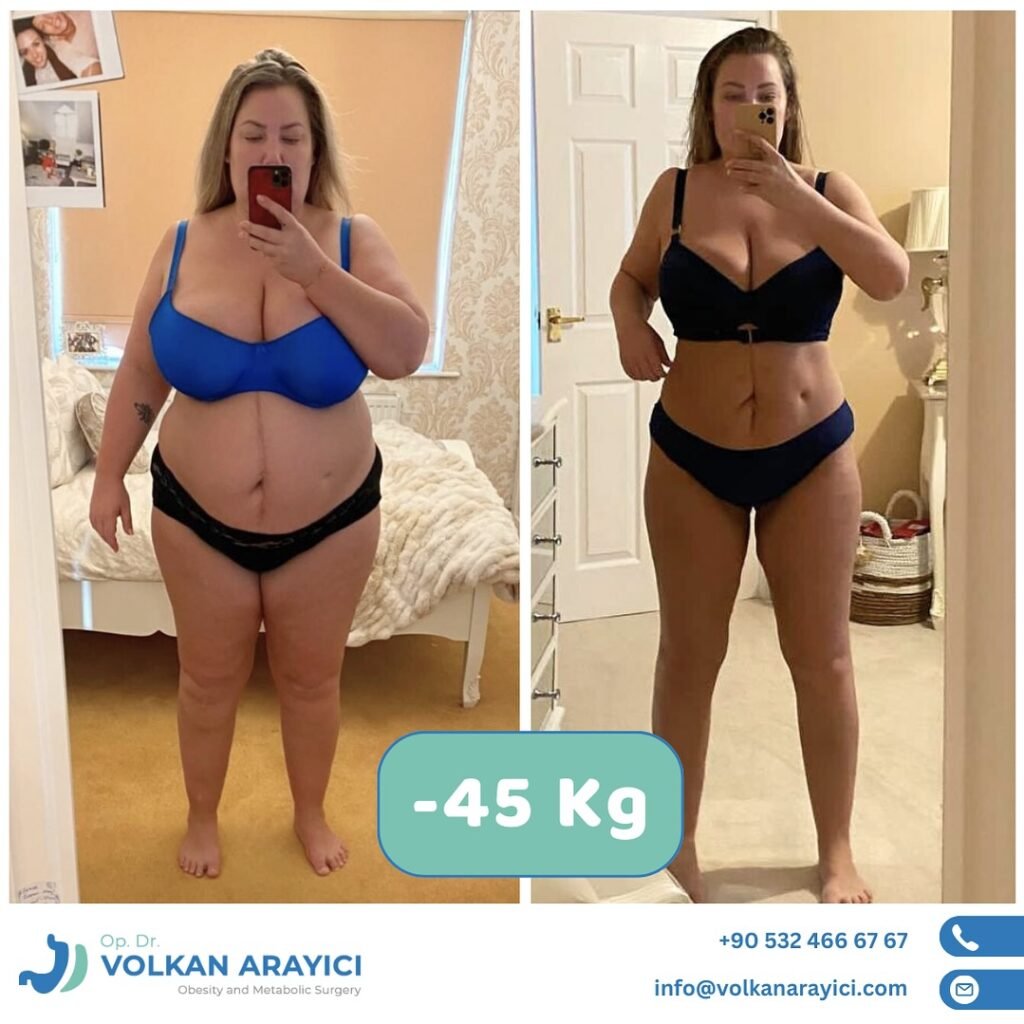 Gastric Sleeve in Turkey before and after photo