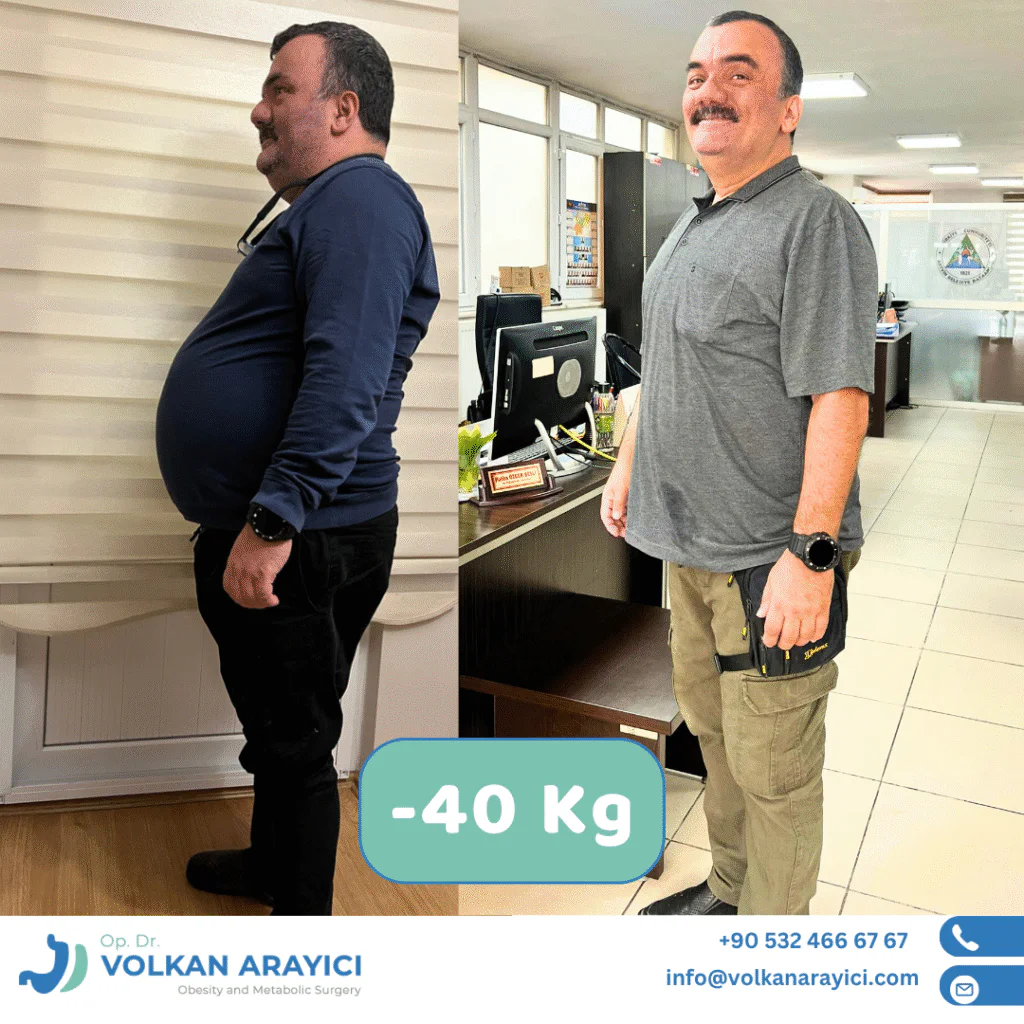 Magenverkleinerung Türkei Schlauchmagen in der Türkei Vorher Nachher